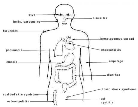 Sites of infection and diseases caused by Staphylococcus aureus.